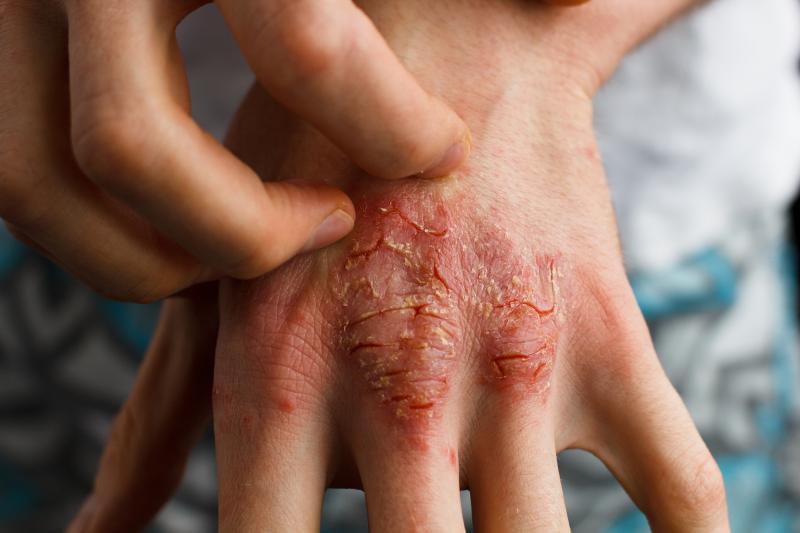 Long-term risankizumab safe, effective in moderate-to-severe plaque psoriasis