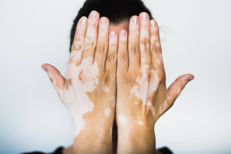 Oral ritlecitinib safe, effective for treatment of active nonsegmental vitiligo
