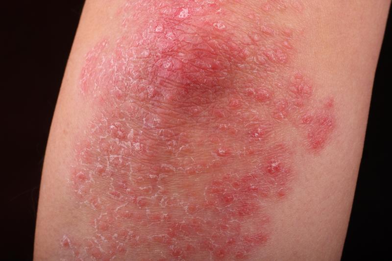 Drug survival higher for ixekizumab vs secukinumab in moderate-to-severe plaque psoriasis