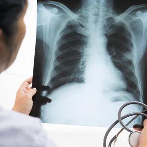 A higher percentage of TB patients in outbreak found to have normal chest X-ray