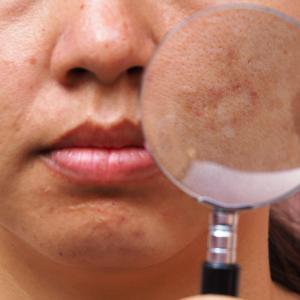 New paradigms in facial hyperpigmentation management