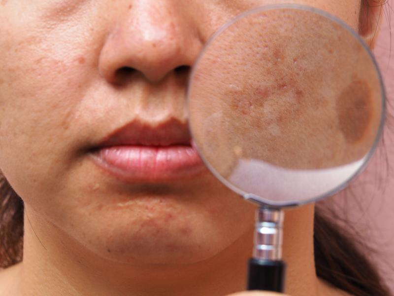 New paradigms in facial hyperpigmentation management
