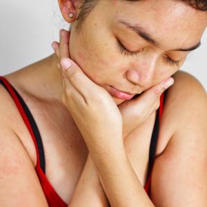 Rituximab induces good remission rates in pemphigus vulgaris