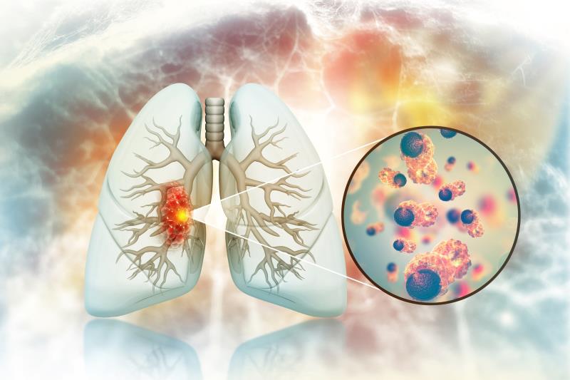 SABR hits efficacy, safety targets for NSCLC with interstitial lung disease