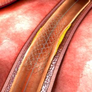 Autoimmune disorders compromise recovery after percutaneous coronary intervention