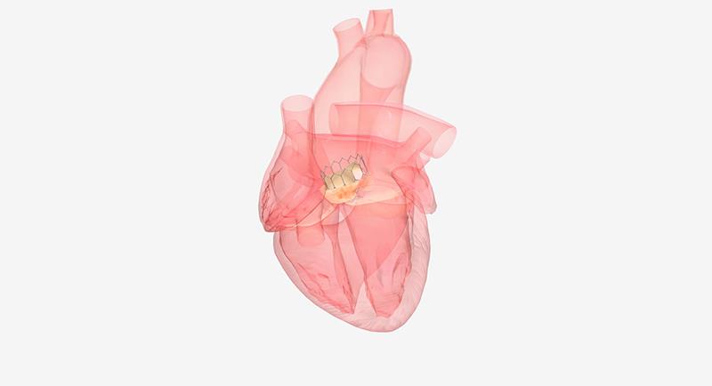 TAVI superior to surgery in women with aortic stenosis
