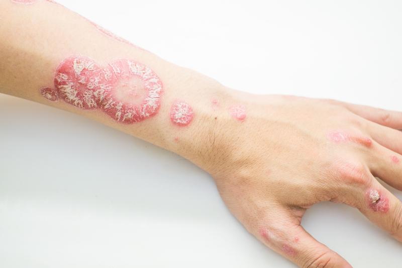 Secukinumab safe, effective for moderate-to-severe plaque psoriasis