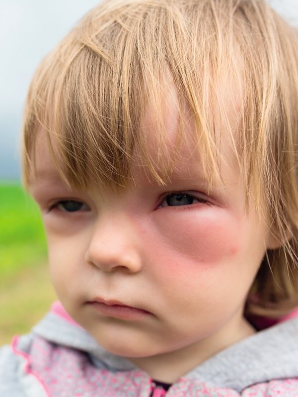 Anaphylaxis (Pediatric)