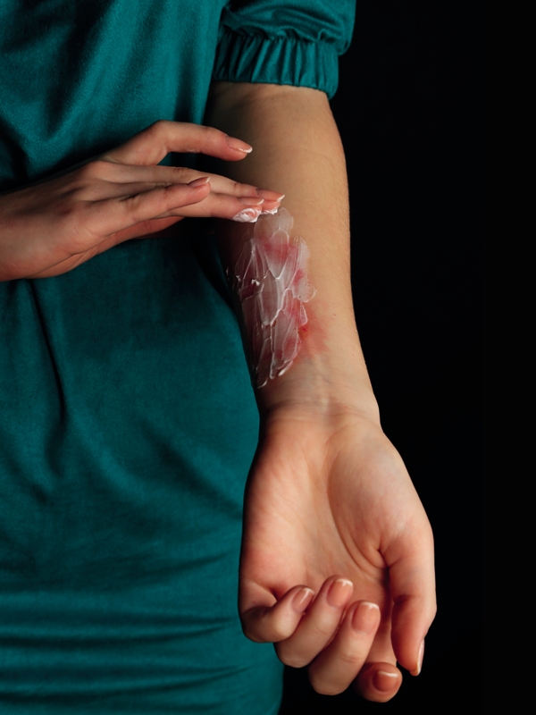 Burns - Initial Management