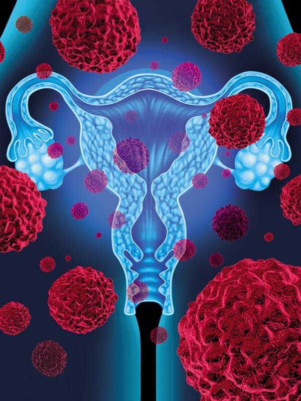 Cervical Cancer - Treatment