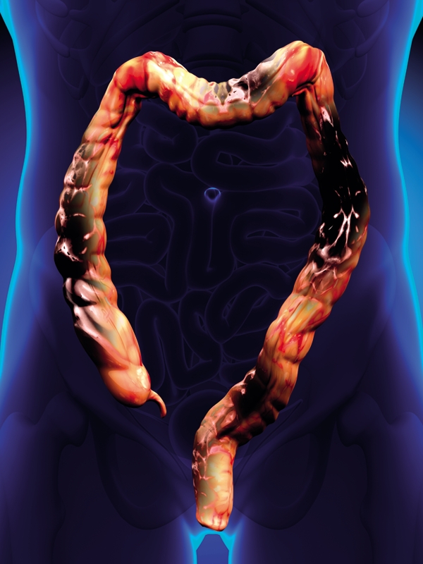 Colorectal Cancer
