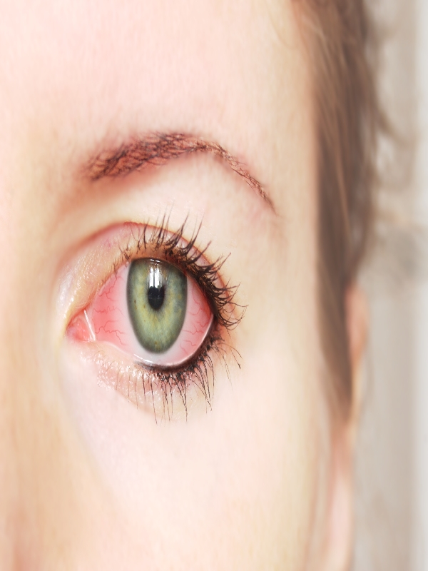 Conjunctivitis - Viral