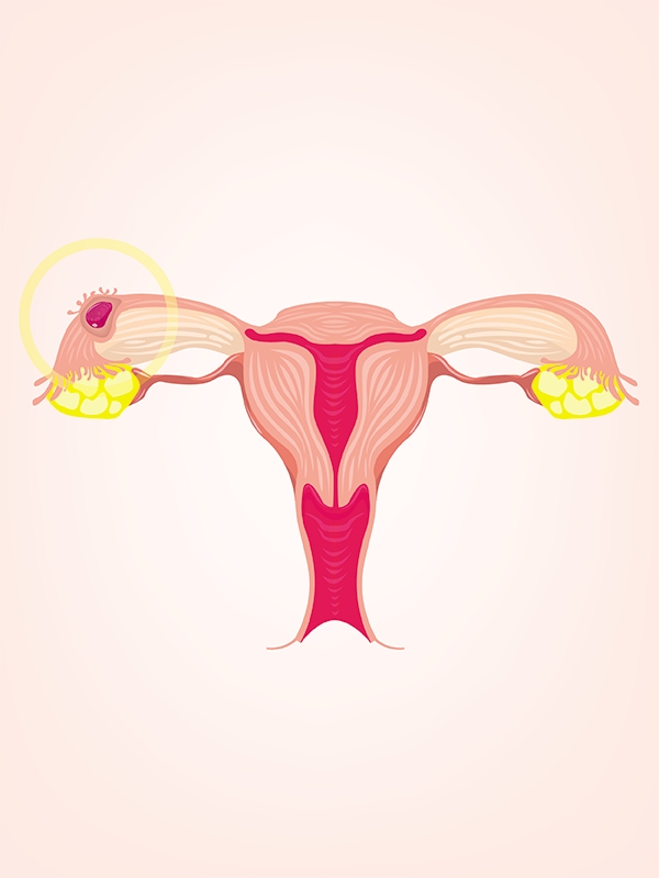 Ectopic Pregnancy