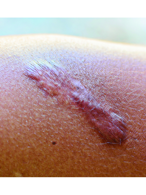 Keloids and Hypertrophic Scars