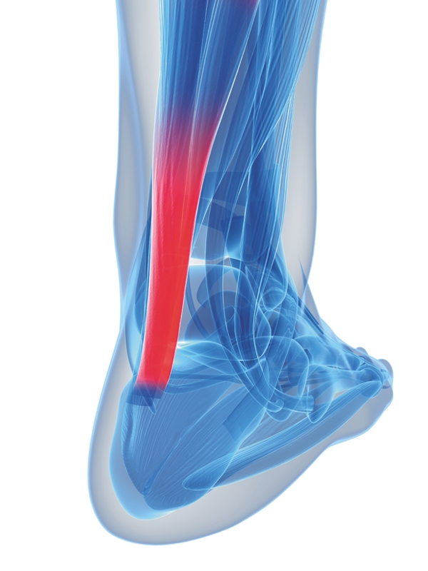 Tendinopathy