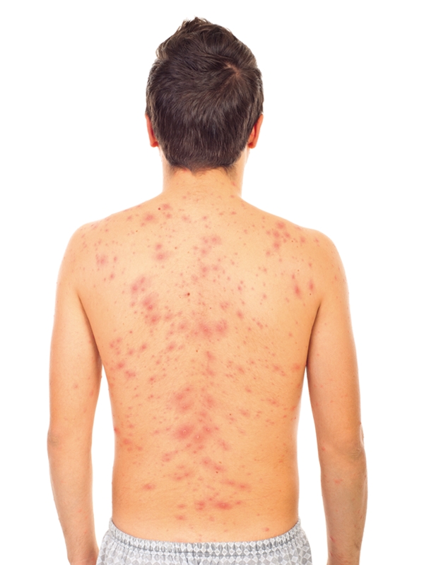 Varicella