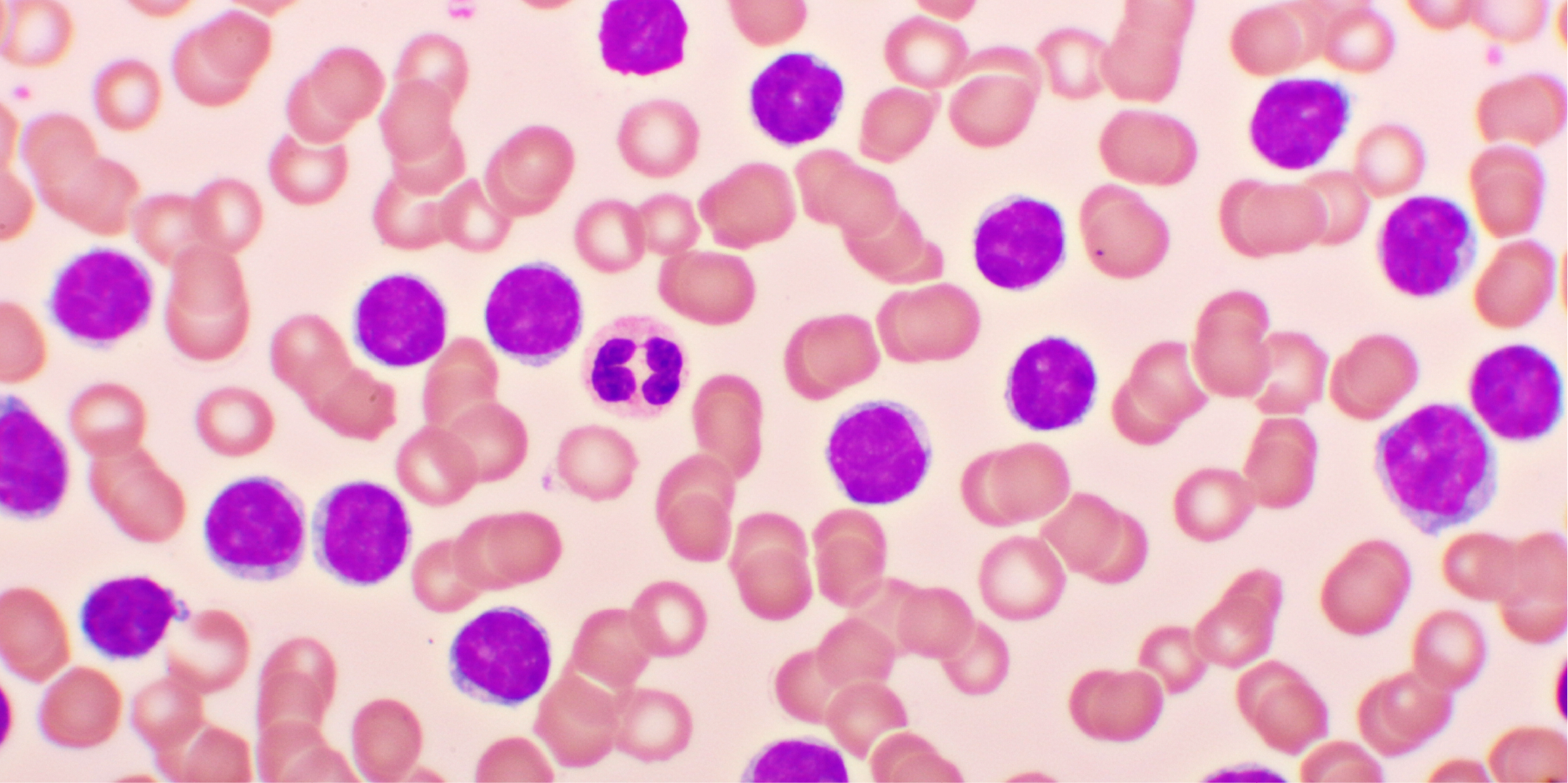 Chronic Lymphocytic Leukemia_Disease Background