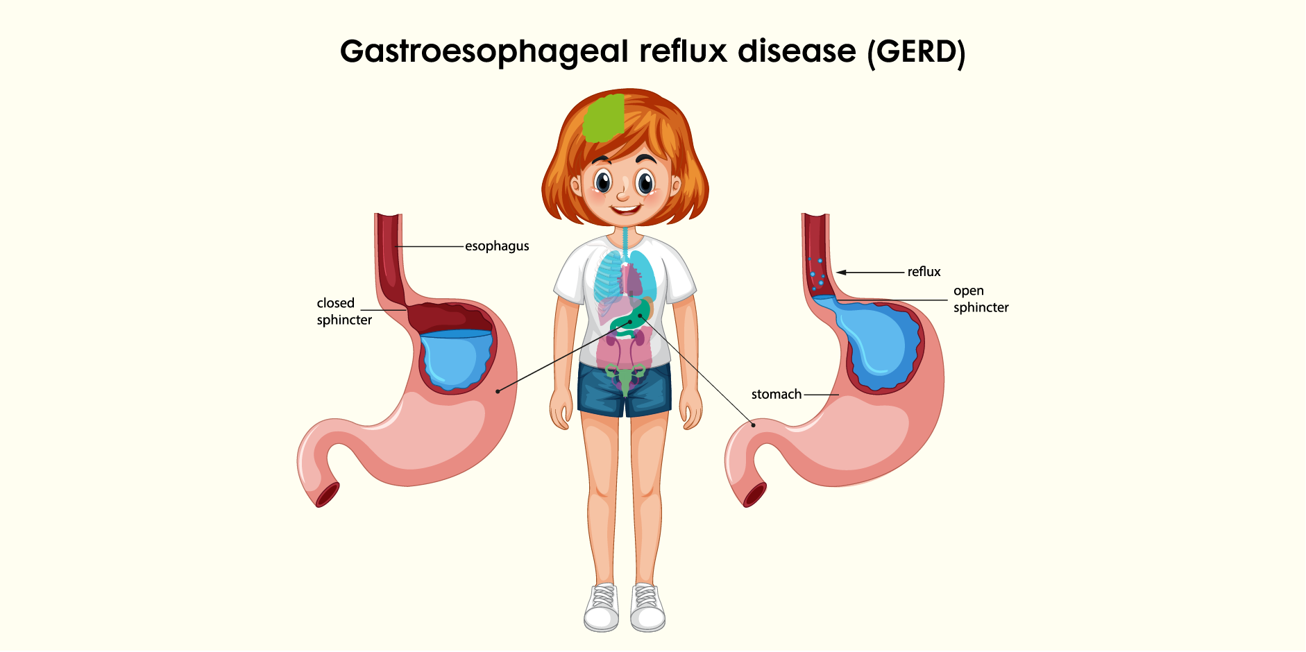 GERD in Children_Disease Background