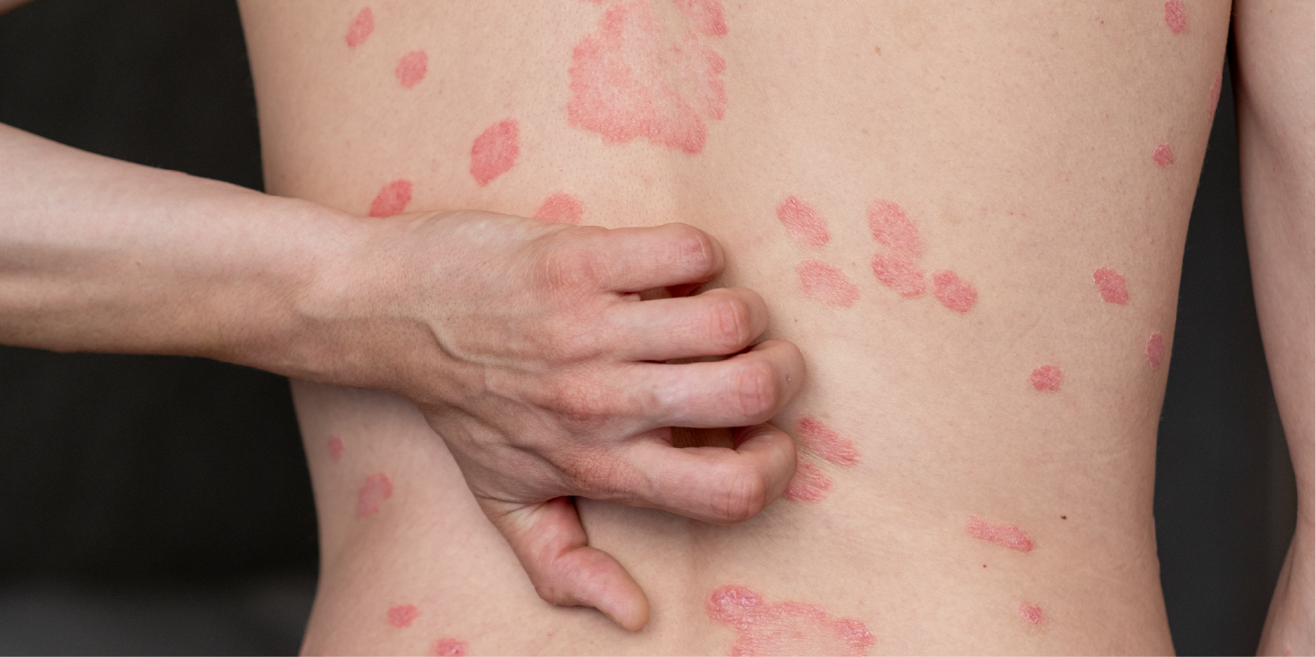 Psoriasis_Initial Assesment
