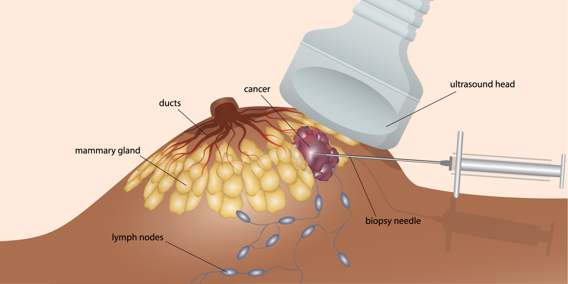 Breast Cancer_Diagnostics 1
