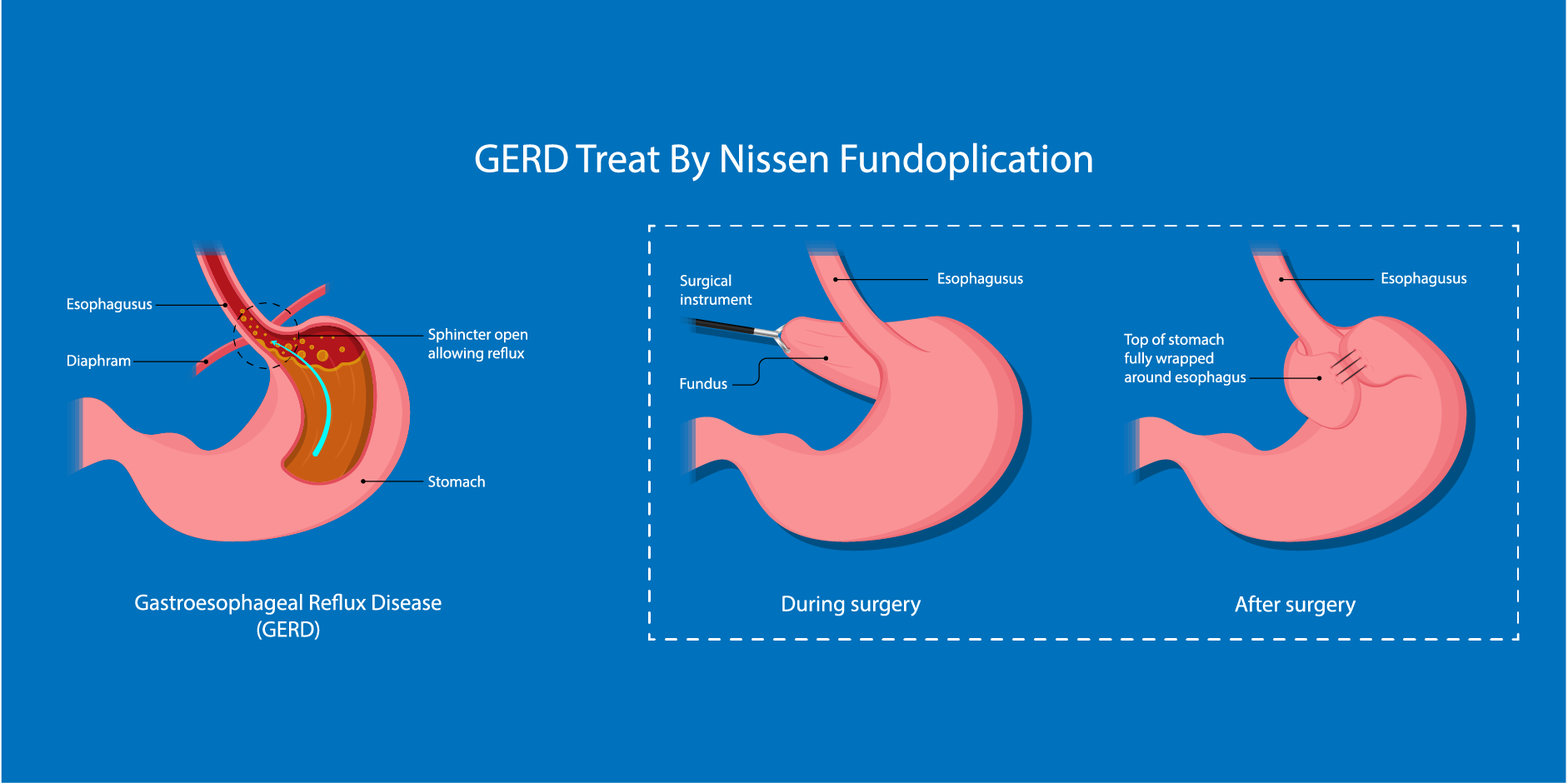 GERD in Children_Management2