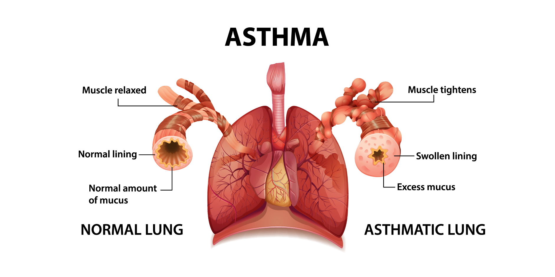 Asthma_Disease Background_1