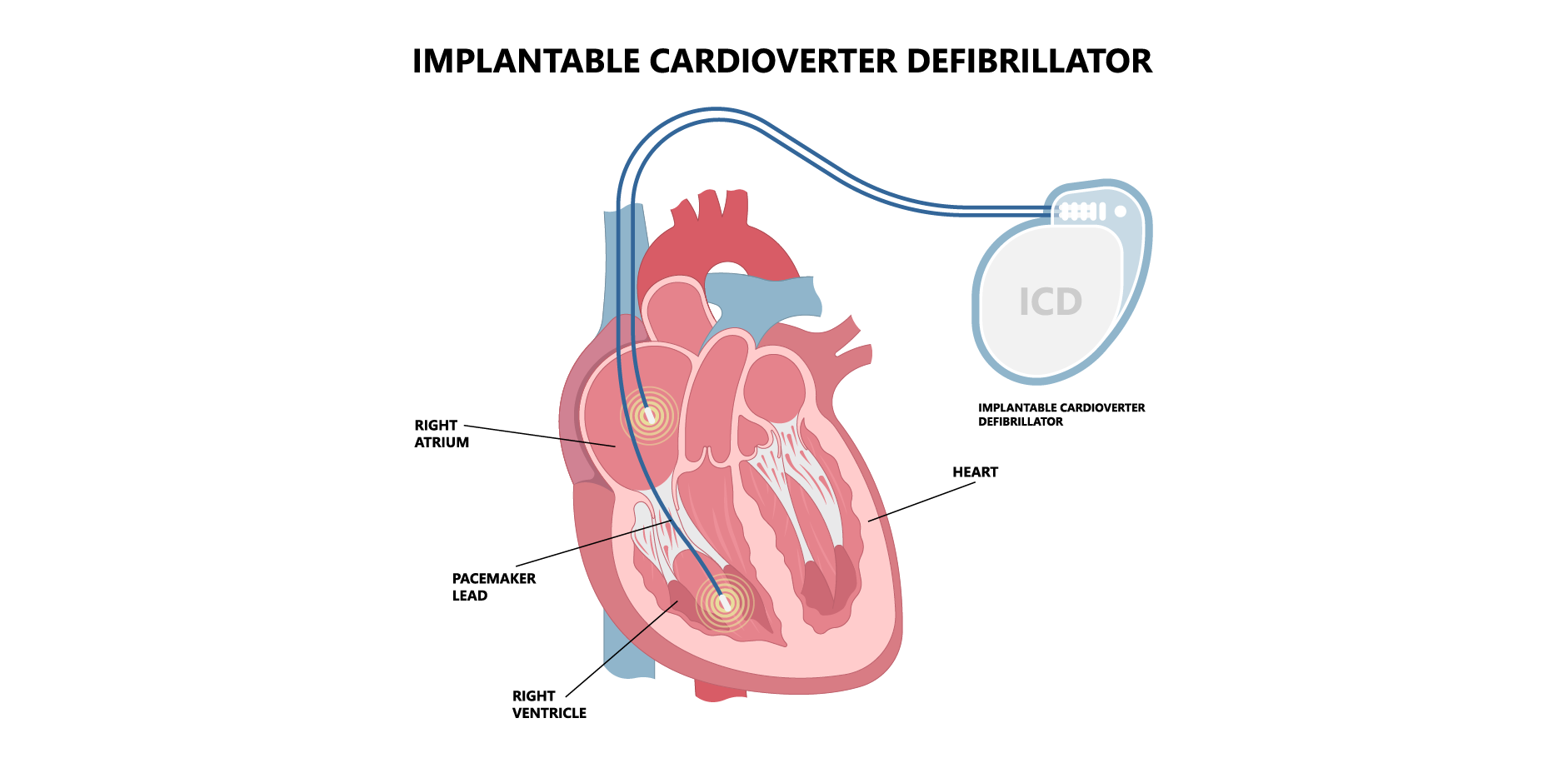 Heart Failure - Chronic_Management