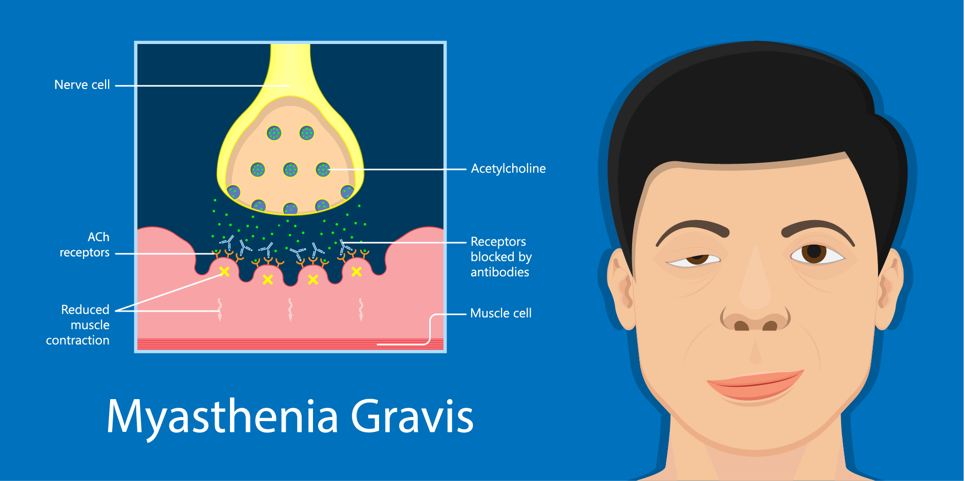 Myasthenia Gravis_Disease Background