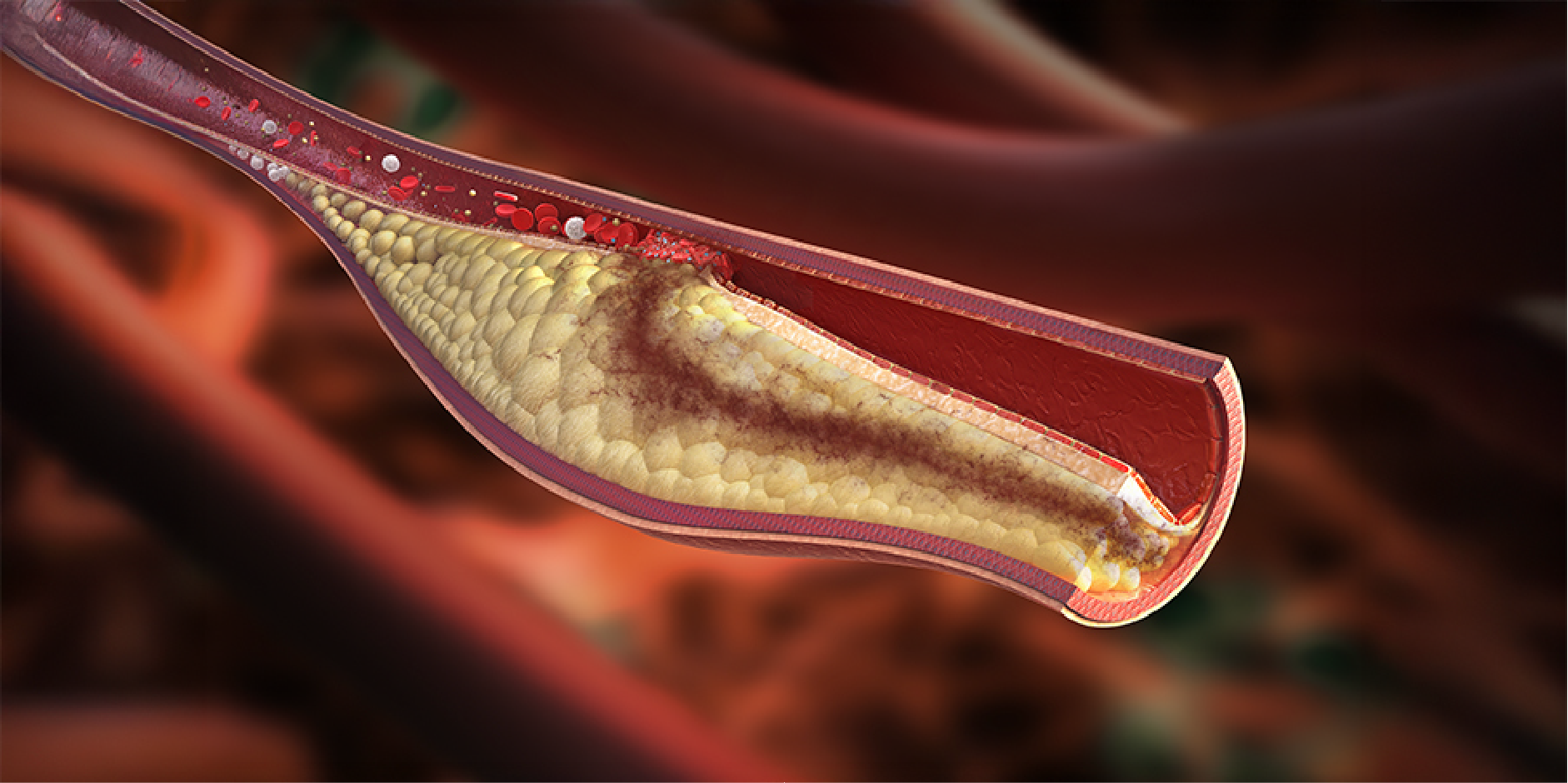 Acute Coronary Syndromes w.out Persistent ST-Segment Elevation_Disease Background 2