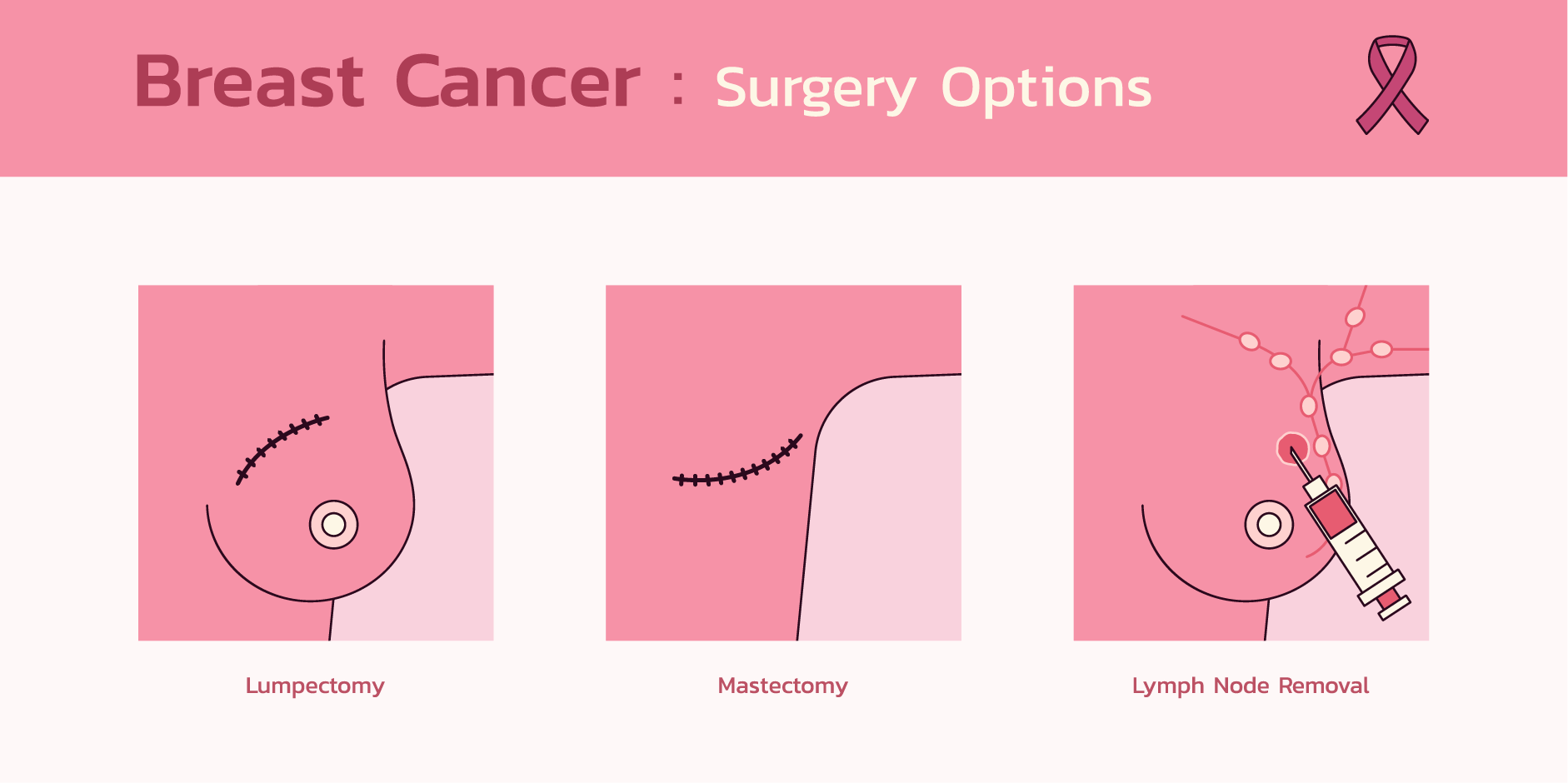 Breast Cancer_Management 2
